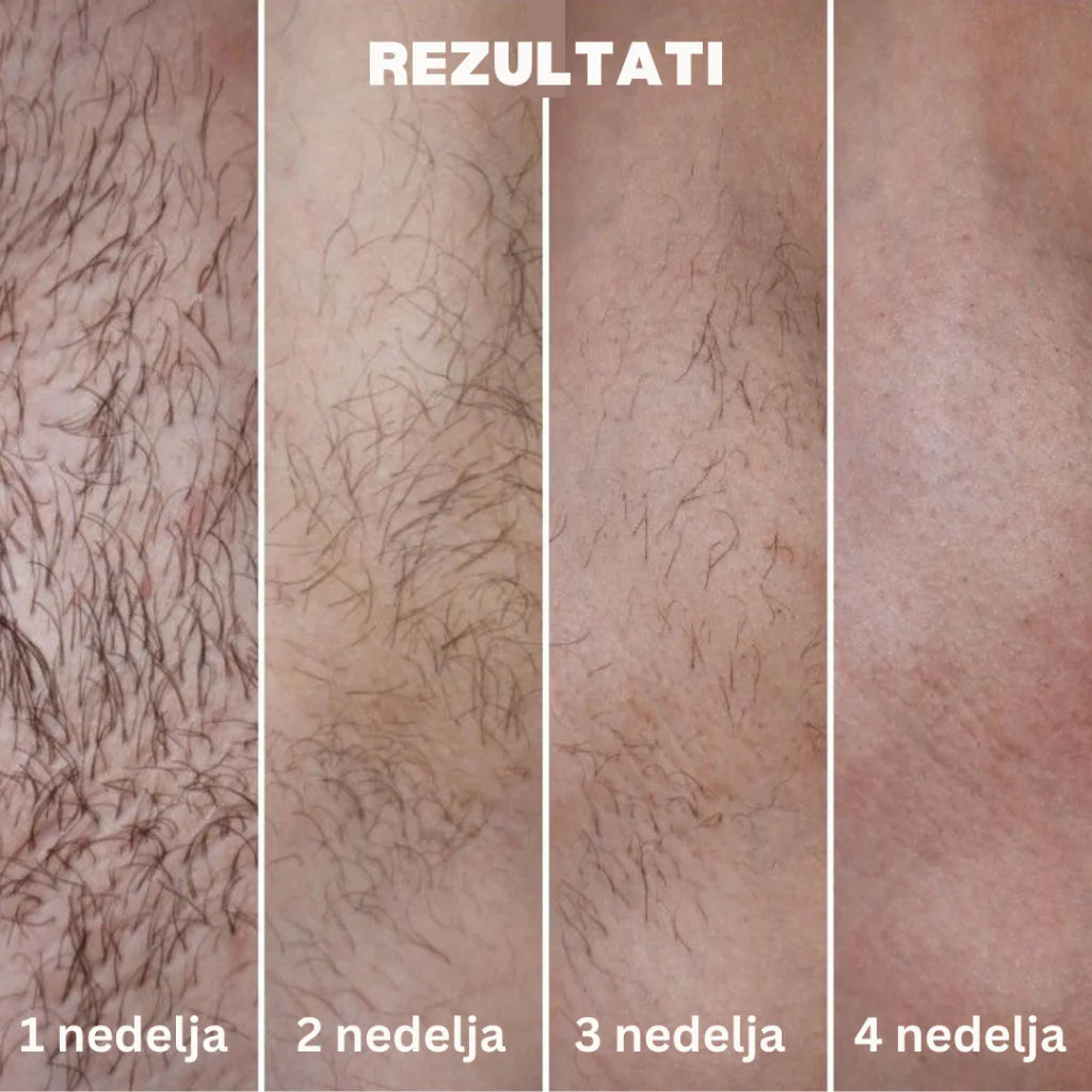 Laserski Epilator Verzija 2.0 - Nova Generacija